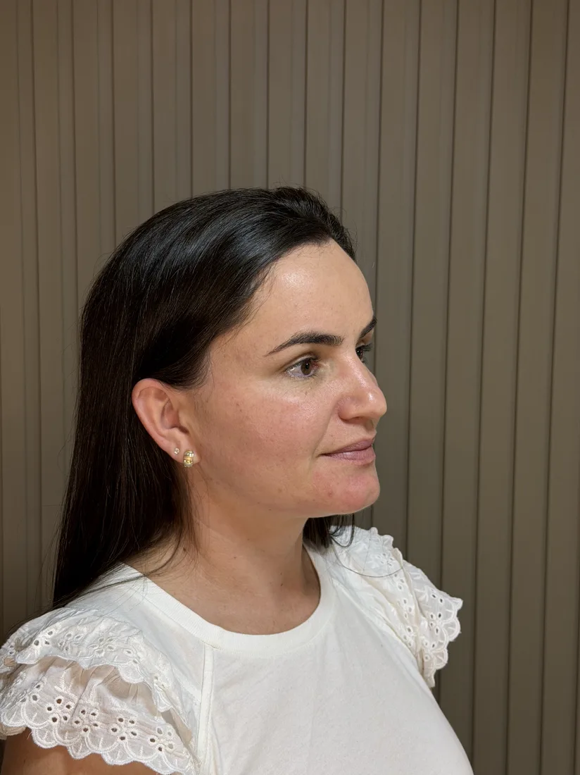 Antes do preenchimento facial