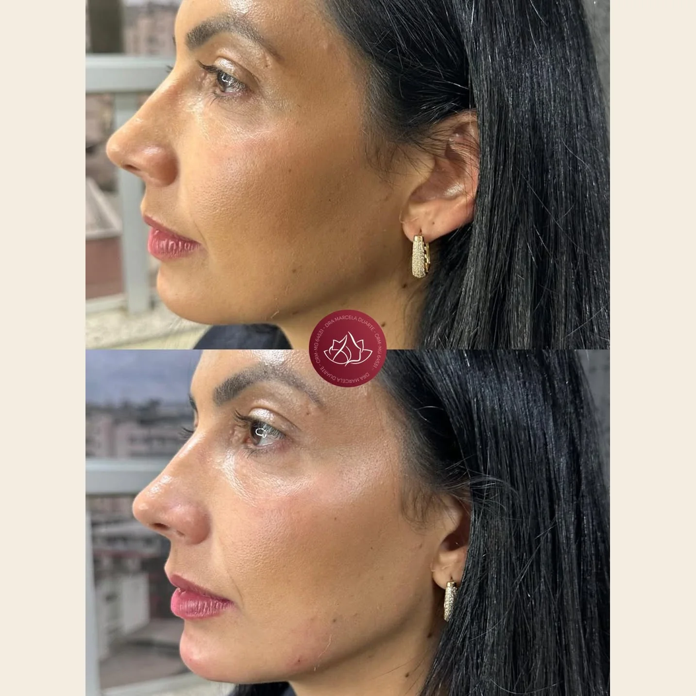 Harmonia facial com preenchimento de mento